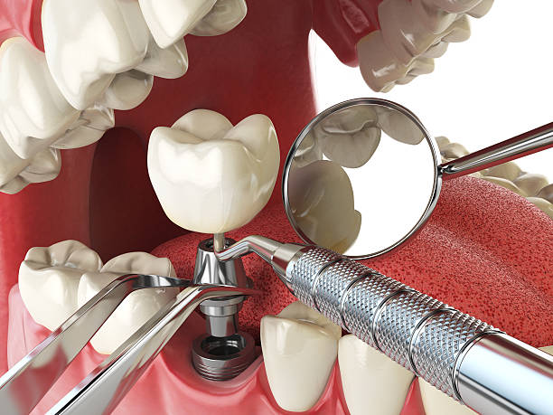 Best Emergency Cosmetic Dentistry (e.g., broken veneers) in Warrensburg, IL